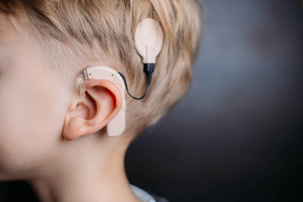 Bone Conduction Implants in Bangalore: Advanced Hearing Solutions with Dr. Rohit